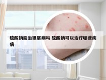 硫酸钠能治银屑病吗 硫酸钠可以治疗哪些疾病