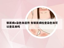 银屑病x染色体遗传 有银屑病检查染色体可以查出来吗