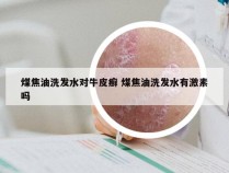 煤焦油洗发水对牛皮癣 煤焦油洗发水有激素吗