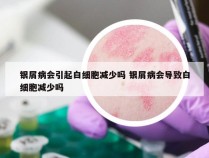 银屑病会引起白细胞减少吗 银屑病会导致白细胞减少吗