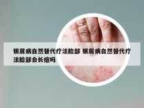银屑病自然替代疗法脸部 银屑病自然替代疗法脸部会长痘吗