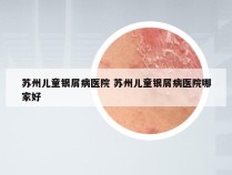 苏州儿童银屑病医院 苏州儿童银屑病医院哪家好