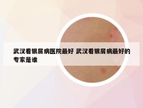 武汉看银屑病医院最好 武汉看银屑病最好的专家是谁