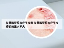 甘草酸苷片治疗牛皮癣 甘草酸苷片治疗牛皮癣的效果大不大