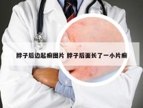 脖子后边起癣图片 脖子后面长了一小片癣