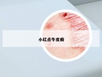 小红点牛皮癣