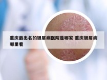 重庆最出名的银屑病医院是哪家 重庆银屑病哪里看