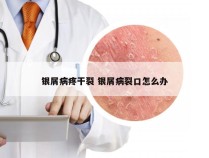 银屑病疼干裂 银屑病裂口怎么办