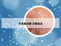 牛皮癣沙棘 沙棘皮炎