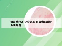 银屑病PASI评分计算 银屑病pasi评分表举例
