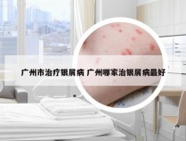广州市治疗银屑病 广州哪家治银屑病最好
