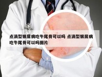 点滴型银屑病吃牛尾骨可以吗 点滴型银屑病吃牛尾骨可以吗图片