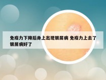 免疫力下降后身上出现银屑病 免疫力上去了银屑病好了