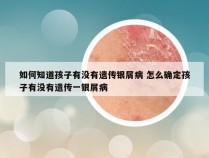 如何知道孩子有没有遗传银屑病 怎么确定孩子有没有遗传一银屑病
