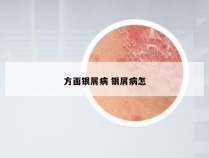方面银屑病 银屑病怎