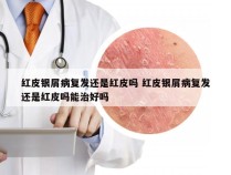 红皮银屑病复发还是红皮吗 红皮银屑病复发还是红皮吗能治好吗