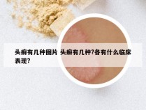 头癣有几种图片 头癣有几种?各有什么临床表现?