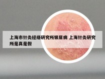 上海市针灸经络研究所银屑病 上海针灸研究所是真是假