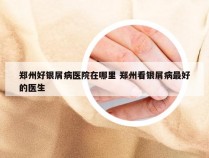 郑州好银屑病医院在哪里 郑州看银屑病最好的医生