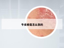 牛皮癣是怎么张的
