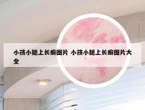 小孩小腿上长癣图片 小孩小腿上长癣图片大全