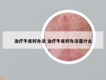 治疗牛皮好办法 治疗牛皮好办法是什么