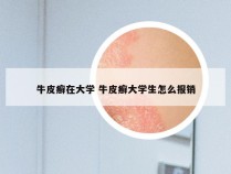 牛皮癣在大学 牛皮癣大学生怎么报销