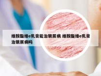 维胺酯维e乳膏能治银屑病 维胺酯维e乳膏治银屑病吗