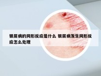 银屑病的同形反应是什么 银屑病发生同形反应怎么处理