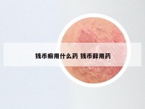 钱币癣用什么药 钱币藓用药