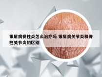 银屑病脊柱炎怎么治疗吗 银屑病关节炎和脊柱关节炎的区别