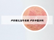 卢氏哪儿治牛皮癣 卢氏中医诊所