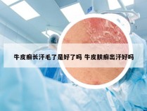 牛皮癣长汗毛了是好了吗 牛皮肤癣出汗好吗
