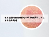 银屑病服用云南白药可以吗 银屑病裂口可以用云南白药吗