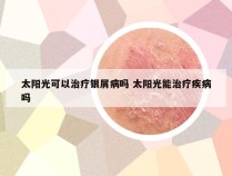 太阳光可以治疗银屑病吗 太阳光能治疗疾病吗