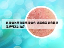 银屑病关节炎是风湿病吗 银屑病关节炎是风湿病吗怎么治疗