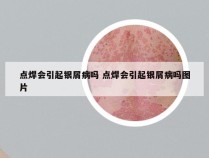 点焊会引起银屑病吗 点焊会引起银屑病吗图片