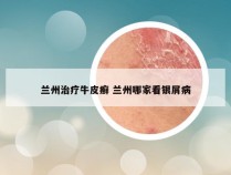 兰州治疗牛皮癣 兰州哪家看银屑病