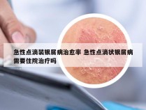 急性点滴装银屑病治愈率 急性点滴状银屑病需要住院治疗吗