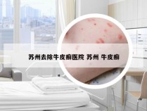 苏州去除牛皮癣医院 苏州 牛皮癣
