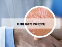 郑州那家看牛皮癣比较好