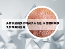 头皮银屑病多长时间洗头合适 头皮银屑病多久会发展到全身
