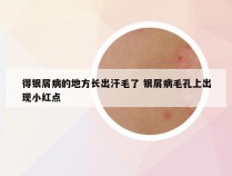 得银屑病的地方长出汗毛了 银屑病毛孔上出现小红点