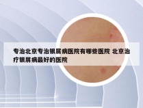 专治北京专治银屑病医院有哪些医院 北京治疗银屑病最好的医院