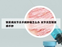 银屑病关节炎手腕肿痛怎么办 关节炎型银屑病手肿