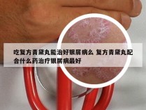 吃复方青黛丸能治好银屑病么 复方青黛丸配合什么药治疗银屑病最好