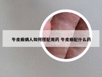 牛皮癣病人如何搭配用药 牛皮癣配什么药