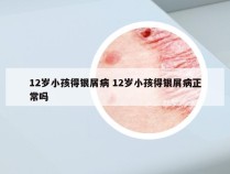 12岁小孩得银屑病 12岁小孩得银屑病正常吗