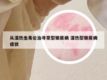 从湿热虫毒论治寻常型银屑病 湿热型银屑病症状