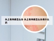 头上有块癣怎么办 头上有块癣怎么办用什么药